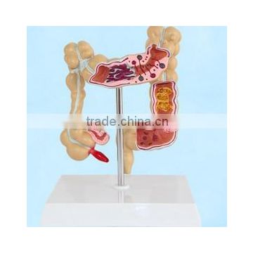 Factory direct supply model of human large intestinal disease model of human organs anatomical medical models