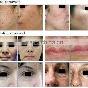 Wrinkle Removal Fractional CO2 Laser With USA RF Tube photo-6