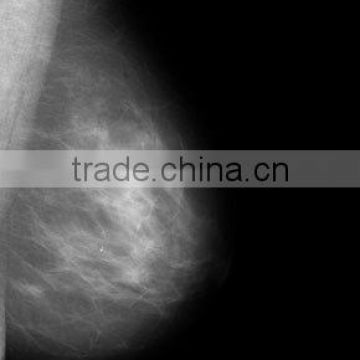 China KND-A/F CE medical dry film mammographie