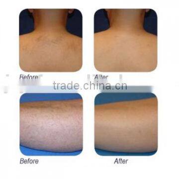 Medical Beauty Diode Laser/808nm Diode Laser Epilator/laser Hair Removal Machine AC220V/110V