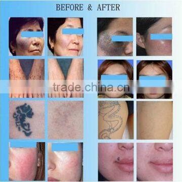 Q Switched nd Yag Laser no Side Effects/nd-yag Q-switched Laser Skin Treatment/q Switched nd Yag Laser photo-6