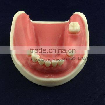 Medical Science Dental Implant Model With Soft Gingiva photo-4