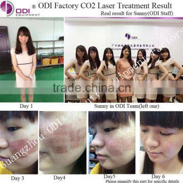 World Best Selling Fractional Co2 Stretchmark And 10.6um Scar Removal Laser Machine Birth Mark Removal