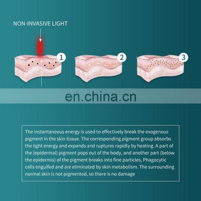 Single Handle Non-invasive Tattoo Removal Laser Machine Q Switch Nd Yag Laser Eyebrow Washing Instrument Pigment Spot Removal