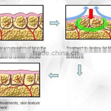 Vertical Body Shaping Weight Loss Ultrasonic Cavitation Radio Frequency Beauty System photo-4