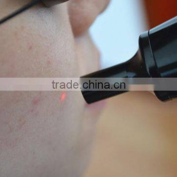 Brown Age Spots Removal Best Tattoo Removal Machine 800mj Q Switch Nd Yag Laser Naevus Of Ito Removal