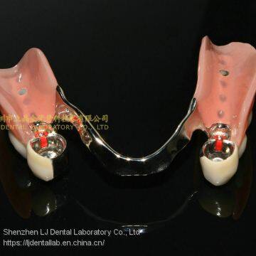 Dental attachment, TK1 precision attachment, dental denture, laboratoire dentaire, Dentallabor, laboratorio dental, dental laboratory, Shenzhen LJ dental lab China
