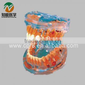 A pathological model transparent tooth BIX - L1008