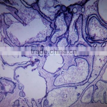 biological educational oral pathology slides,adamantoblastoma histology oral pathology slides