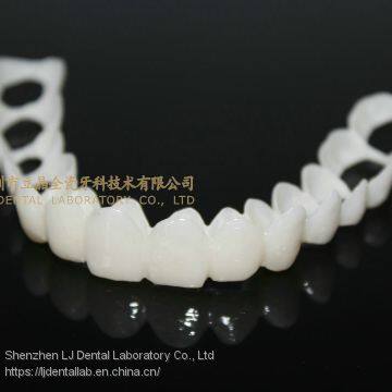 CAD/CAM PMMA Resin Clip on Veneers, Snap-on-veneers, Smile Veneers, Laboratoire Dentaire, Dentallabor, Laboratorio Dental, Dental Laboratory, Shenzhen LJ Dental Lab China photo-3