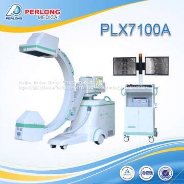 Digital subtraction angiography by HF C arm equipment PLX7100A