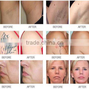 Sales Discount Diode Ipl Hair Removal Facial Whitening Multifunctional Machine photo-5