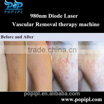 laser Spider vein removal 15W high power / Vascular removal / Blood vessel removal