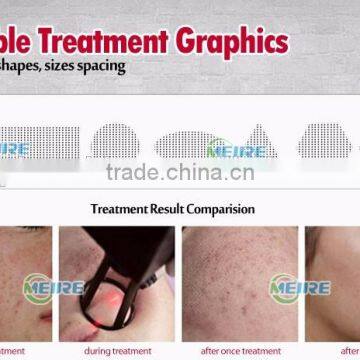 Factory Price CE Approved Fractional Co2 Laser Scar Removal High Quality Fractional Co2 Laser photo-4