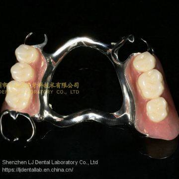 Dental Co-Cr Partial Denture,Titanium Framework Denture, Dental Dentures, Laboratoire Dentaire, Dentallabor, Laboratorio Dental, Dental Laboratory, Shenzhen LJ Dental Lab China photo-3