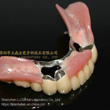 Dental Telescope Denture, Telesope Crown, Dental Prosthesis, Laboratoire Dentaire, Dentallabor, Laboratorio Dental, Dental Laboratory, Shenzhen LJ Dental Lab China photo-5