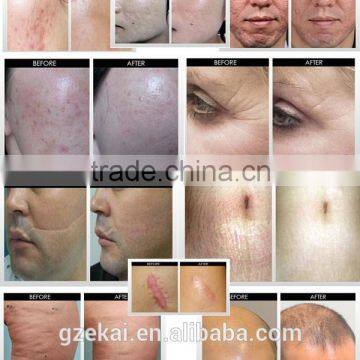 DNS 180 Micro Fine Needles Eyes Derma Roller for Crows Feet / Eye Wrinlke photo-5