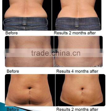 2017 Advanced Beijing Sincoheren Cellulite Freezing Cool Shaping Machine for Weight Loss photo-2