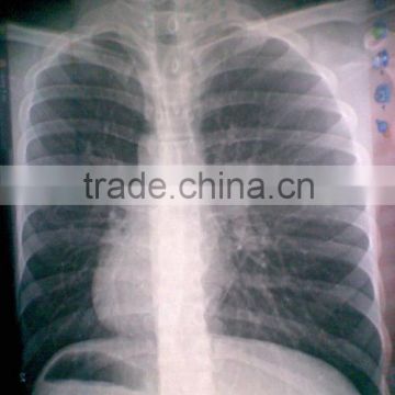 medical x-ray dry film, drystar 14 17 dt2b of china zhejiang