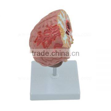 Organs Human Body Anatomy Brain Model Of Stroke photo-2