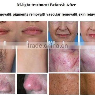 Super Hair Removal Machine With IPL SHR Elight OPT From Beijing Fogool photo-5