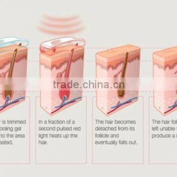 Professional IPL Vein Removal Laser Spring Facial Hair Removal Machine photo-6