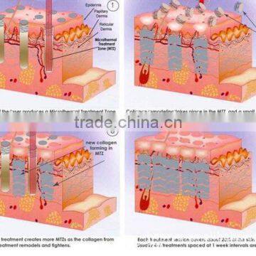 Portable 40W RF Tube Pixel Co2 Fractional Laser With Virginal Tightening photo-4