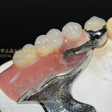 Dental Precision Attachment, Dental Attachment, Dental Denture, Laboratoire Dentaire, Dentallabor, Laboratorio Dental, Dental Laboratory, Shenzhen LJ Dental Lab China photo-4