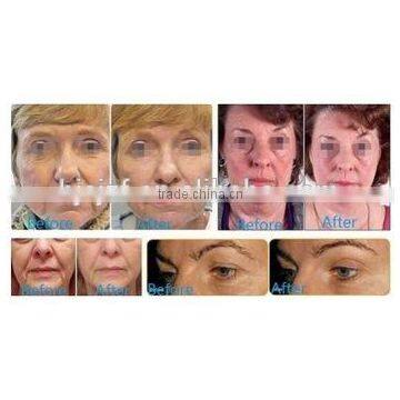 Expression Lines Removal HIFU-C Best Quality Ultrasound Skin Tightening HIFU Machine Hifu Iso13485 Face-lift