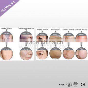 Security and Easy Operation Removing Hair Pigment Reduction Home Skin Rejuvenation Machine photo-6