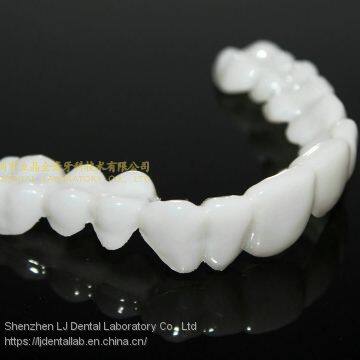 Dental PETG Clip on Veneers, Snap-on-veneers, Smile Veneers, Laboratoire Dentaire, Dentallabor, Laboratorio Dental, Dental Laboratory, Shenzhen LJ Dental Lab China