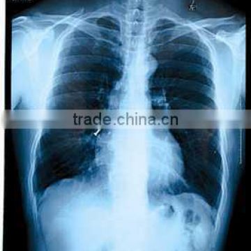 China KND-A/F CE medical dry film rayos x de torax