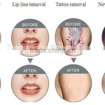 Portable Tattoo Removal Machine photo-3