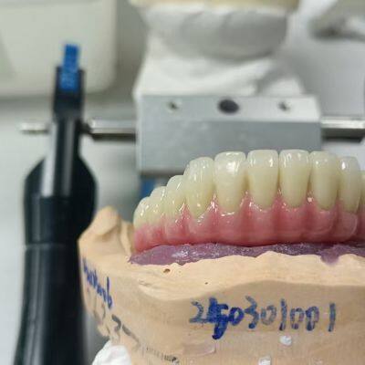 CAM Milled Titanium Bar Dental Implant Hybrid Prosthesis Dentures Metal Implant Bar
