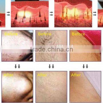 New Products 2016 808nm Diode Laser Hair Removal Machine photo-6