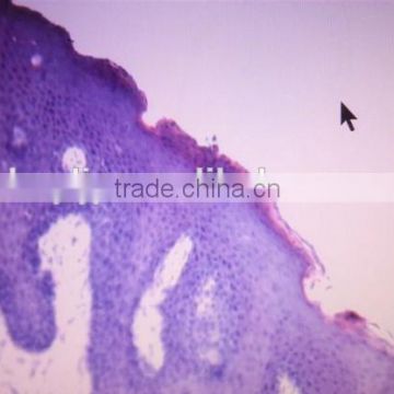 oral leukoplakia Human oral tooth pathological pathology prepared teaching slides