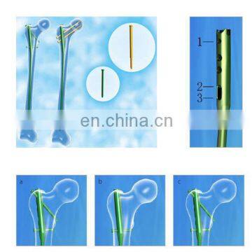 Humerus Interlocking Nail photo-6