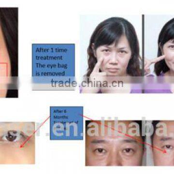 New Products 2016 Dark Eye Circle Removal Eye Beauty Machine