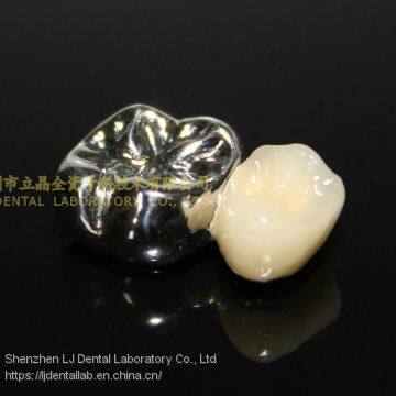 Full Metal Crown, FMC, FGC, Full Metal Post Core, Dental Crown, Cast Metal Crown, Dental Prosthesis, Laboratorio Dental, Dental Laboratory, Dentallabor, LJ Dental Lab China photo-2