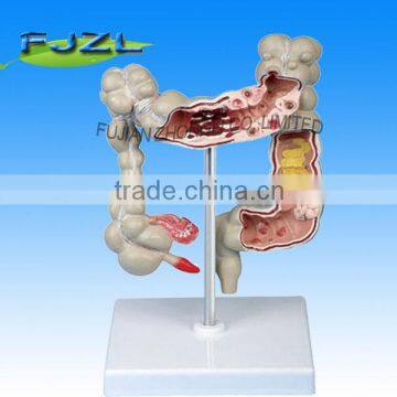 human Disease Large Intestines Model