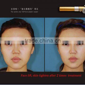 2015 Hot Selling!!!cdt Carboxy Therapy , Cdt Carboxy Therapy Insrtument photo-6