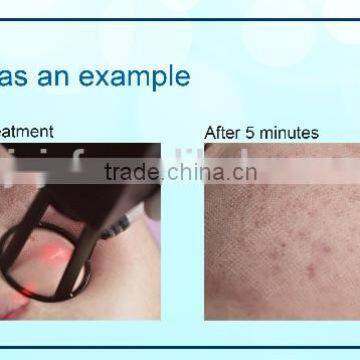 Acen and Scar Removal, Portable CO2 Fractional Laser