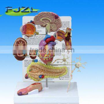 Mini Set human Anatomical Model-Type II Diabetes