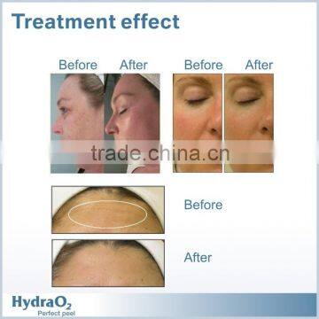 Portable Oxygen Facial Machine For Skin Rejuvenation Skin Whitening Mini Oxy Skin Oxygen Jet Diamond Dermabrasion photo-5