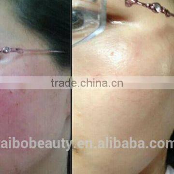 Distributor Low Price ! 980nm Spider Vein Removal Machine Vascular Remover 980 Varicose Vein Laser photo-3