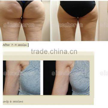 Kuma Shape Venashape Vaccum RF Massager Body Slimming Weight Loss Machine photo-6