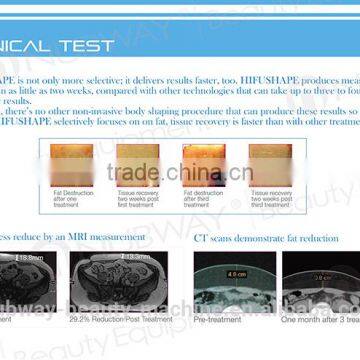 NEWS!!! 2015 HIFUShape Non-invasive Hifu Slimming/hifu Fat Reduction photo-4
