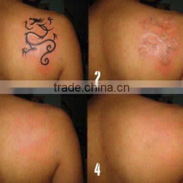 Pigmented Lesions Treatment 1320nm Carbon Powder Skin Whitening Tattoo Removal Laser Machine Q Switch Nd Yag Laser Tattoo Removal Machine photo-4