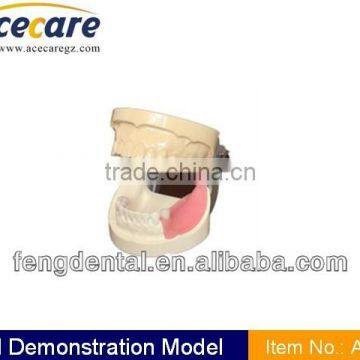 Hot sale and high quality Implant practice model AC-P7