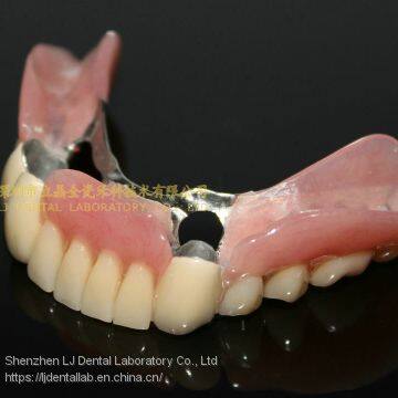 Dental Telescope Denture, Telesope Crown, Dental Prosthesis, Laboratoire Dentaire, Dentallabor, Laboratorio Dental, Dental Laboratory, Shenzhen LJ Dental Lab China photo-3